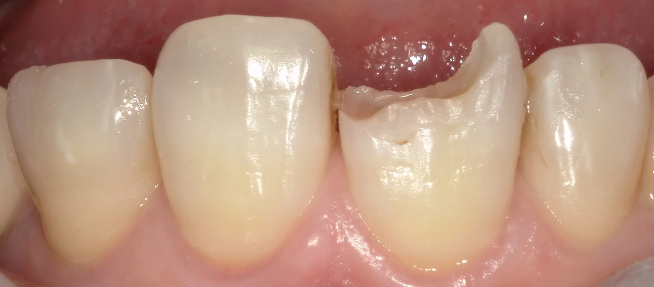 前歯が折れてしまったケース。|坂寄歯科医院(取手市藤代) - 画像2