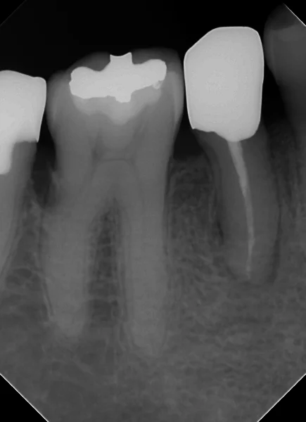 閉鎖根管の治療には根気が必要｜坂寄歯科医院（取手市藤代） - 画像4