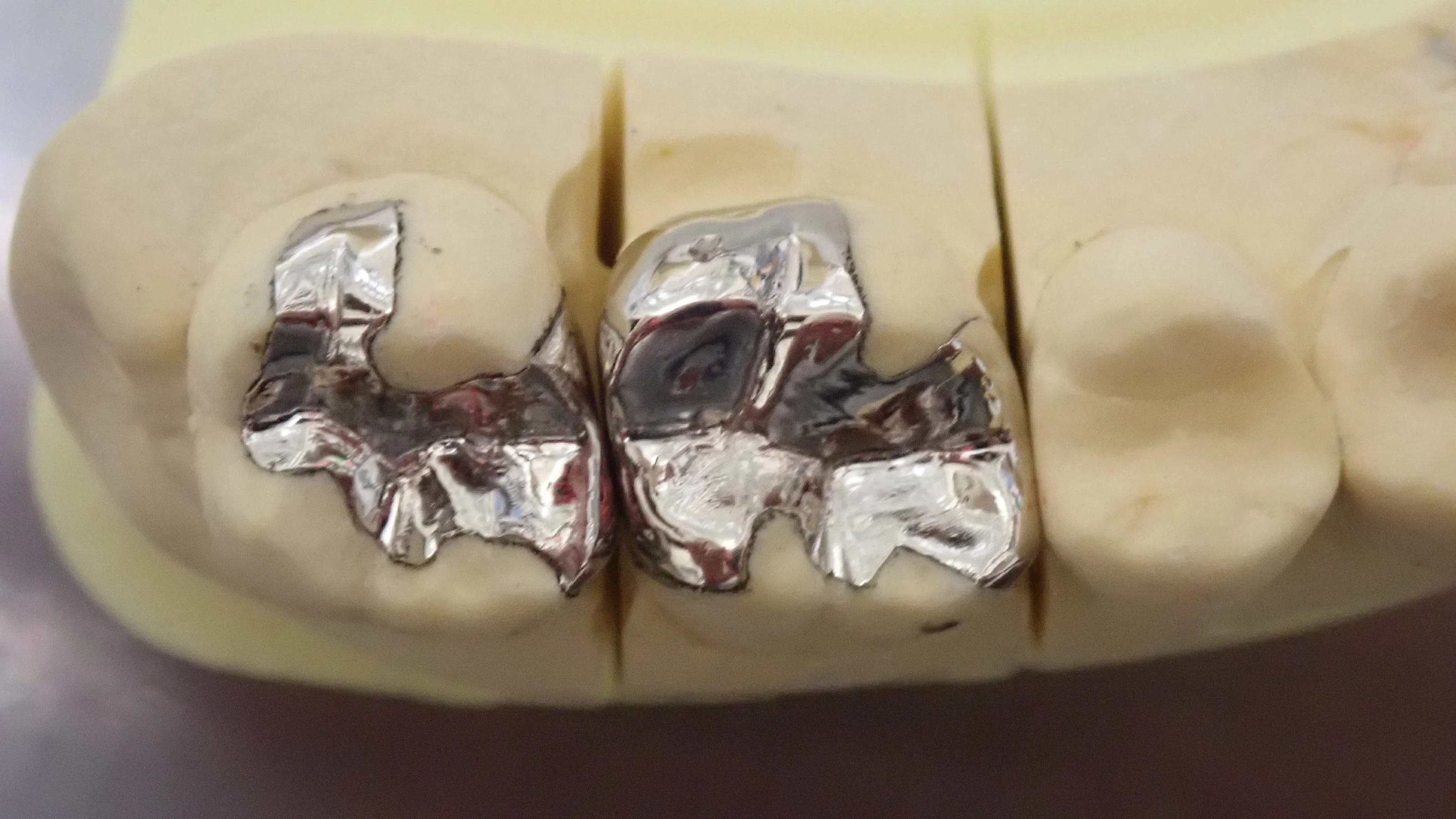 メタルインレー｜坂寄歯科医院（取手市藤代） - 画像2