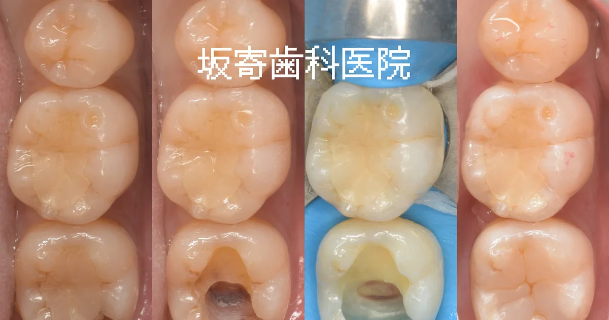 ブログ・お役立ち情報｜坂寄歯科医院（取手市藤代）