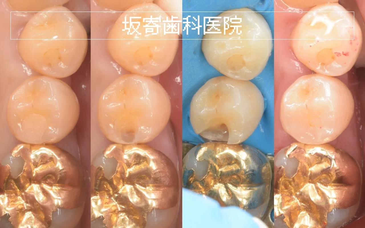 左下5番 遠心2級窩洞 二次う蝕のダイレクトボンディング修復症例（術前・CR除去・う蝕除去・修復後）の写真コラージュ｜坂寄歯科医院
