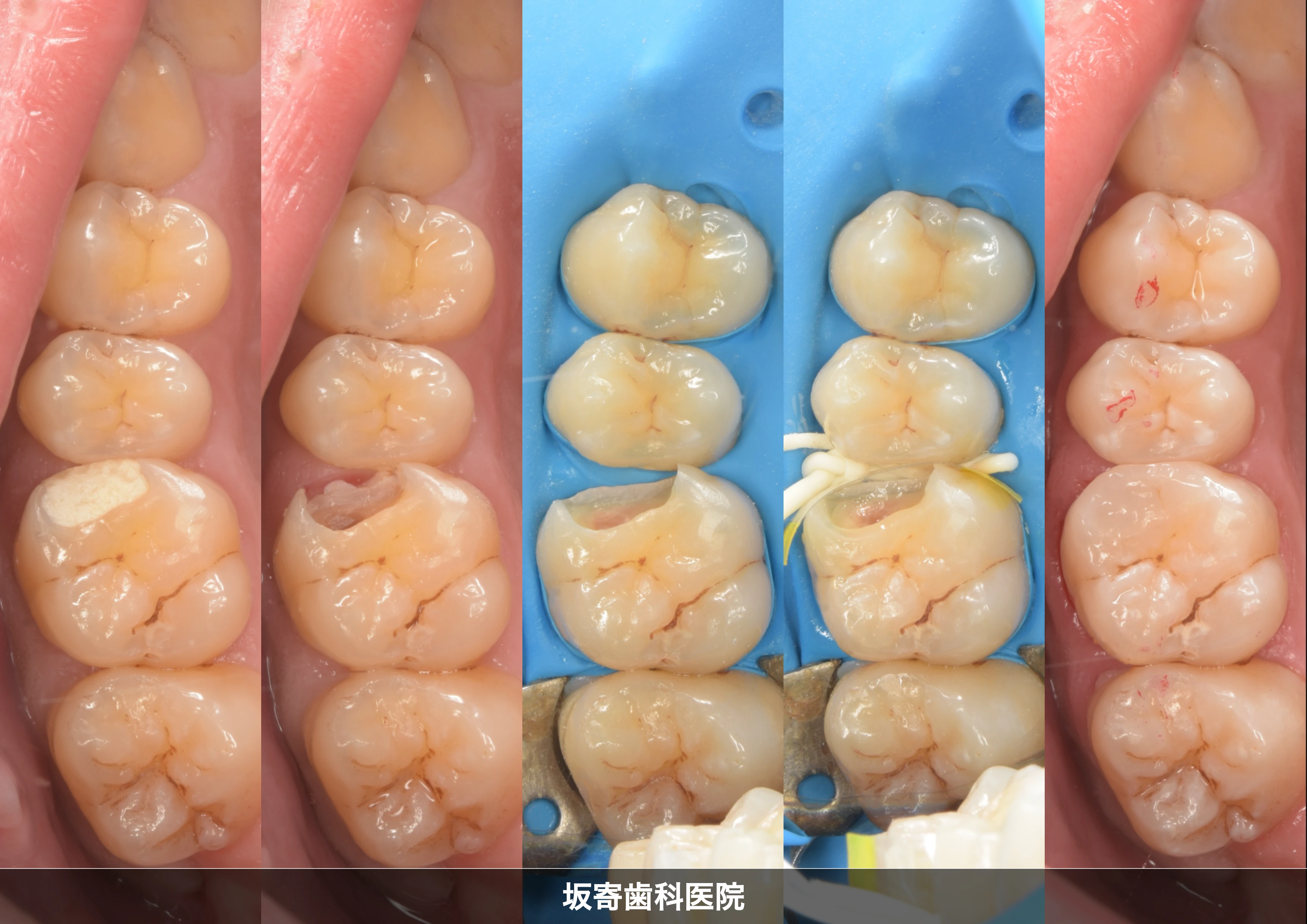 知覚過敏が続く奥歯を精密に再治療｜ダイレクトボンディング症例（左上6・27歳男性）