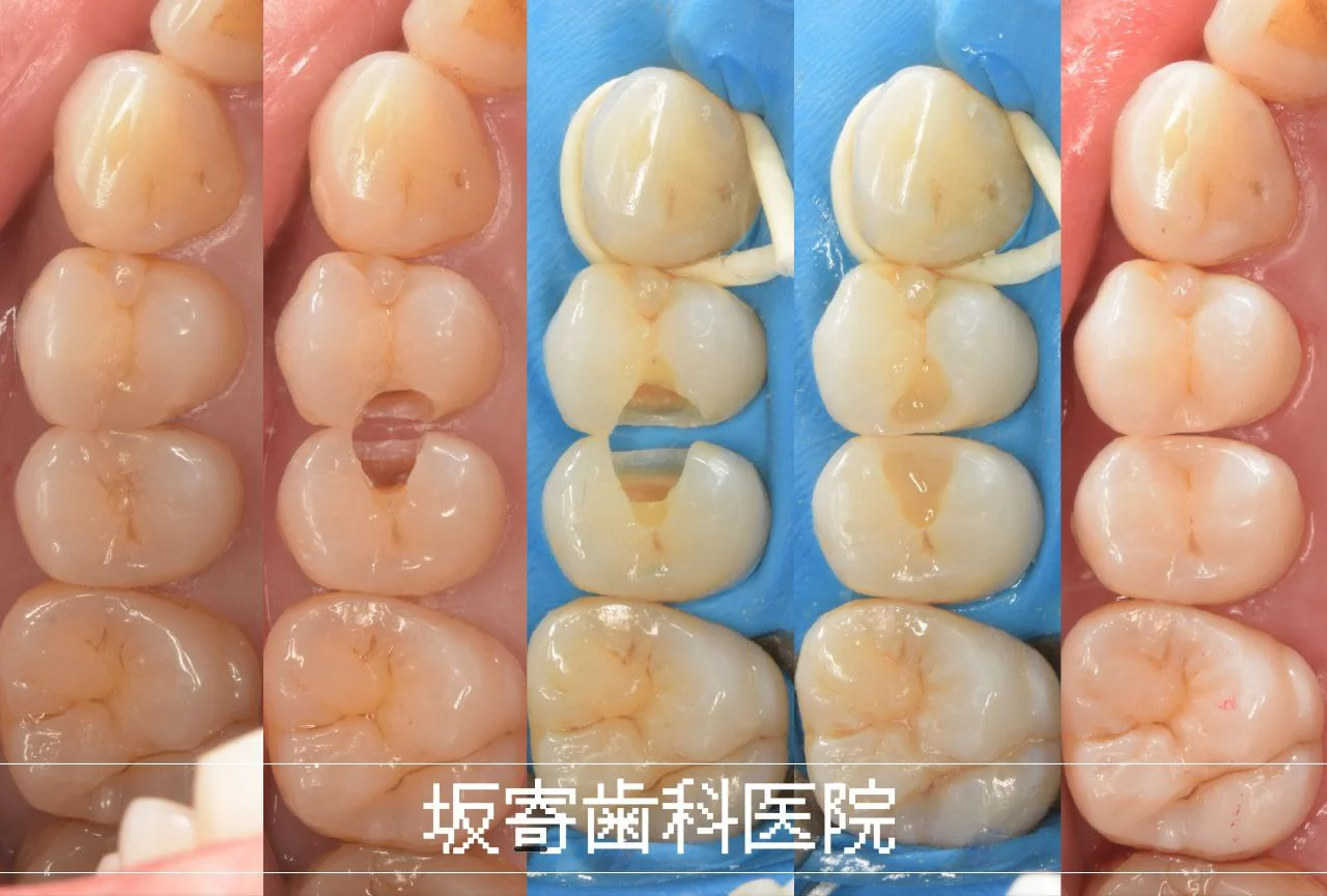 歯をできるだけ削らず再発リスクを抑える奥歯のむし歯再治療｜ダイレクトボンディング症例
