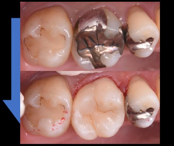 臼歯の金属インレーをダイレクトボンディングで修復した症例②（上：術前／下：術後）