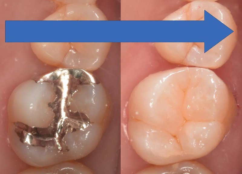 臼歯の銀歯（金属インレー）をダイレクトボンディングで修復した症例①